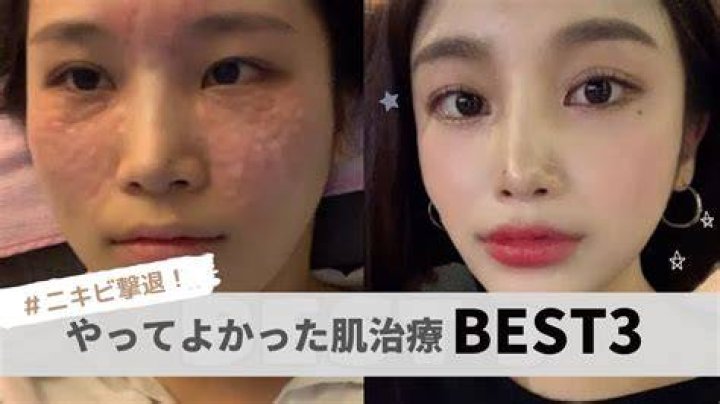 韓国 ニキビ 跡 治療 おすすめ